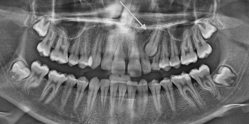 Extração Dentária e Cirurgia na PERFECT SMILE
